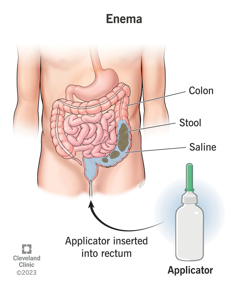 Stool-softening fluid inside a colon following a saline enema injection.