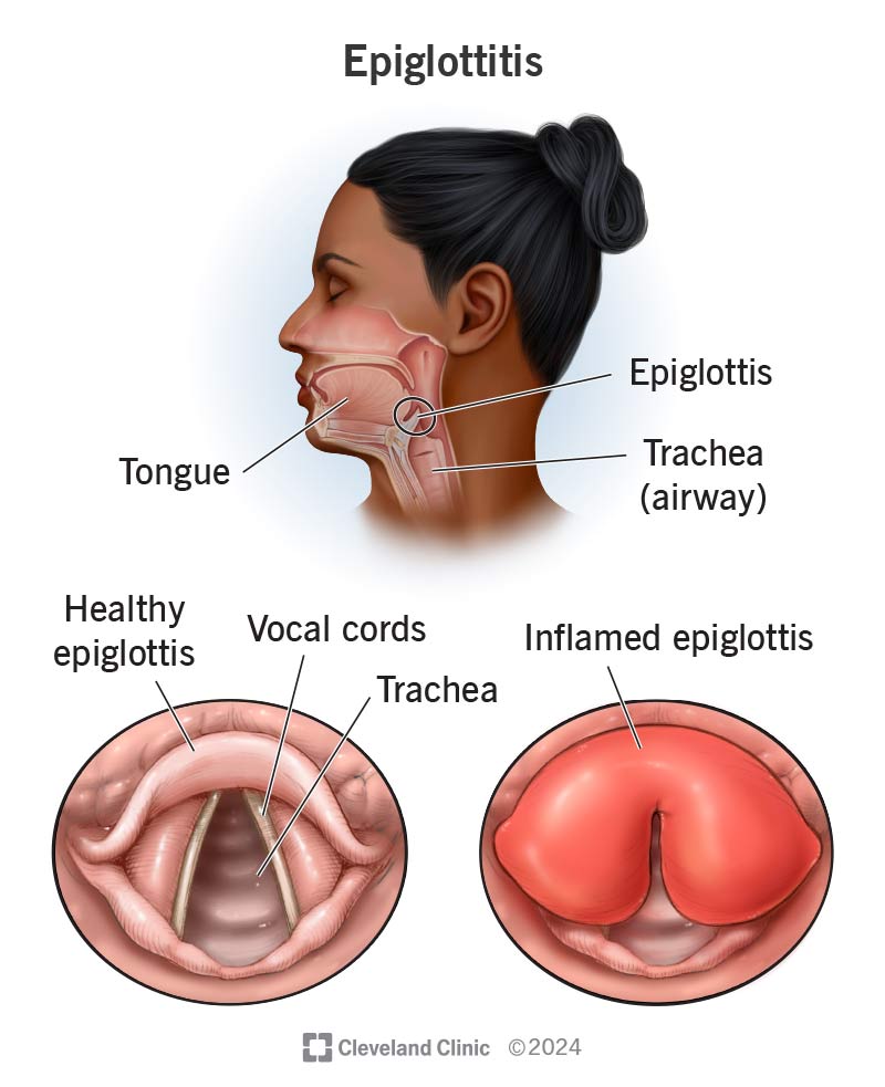 A healthy epiglottis that’s not blocking the trachea versus a swollen epiglottis during an episode of epiglottitis