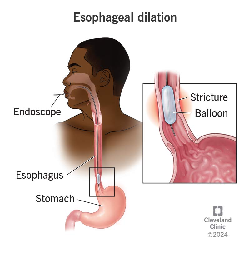 Person having esophageal dilation (endoscope going into mouth and down esophagus) to stretch structure with balloon