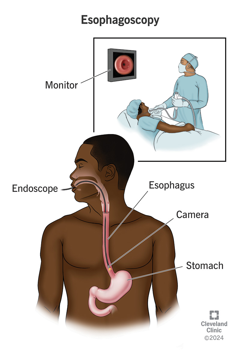 Healthcare providers examine your esophagus, using an endoscope with video camera that sends images to a monitor (inset).