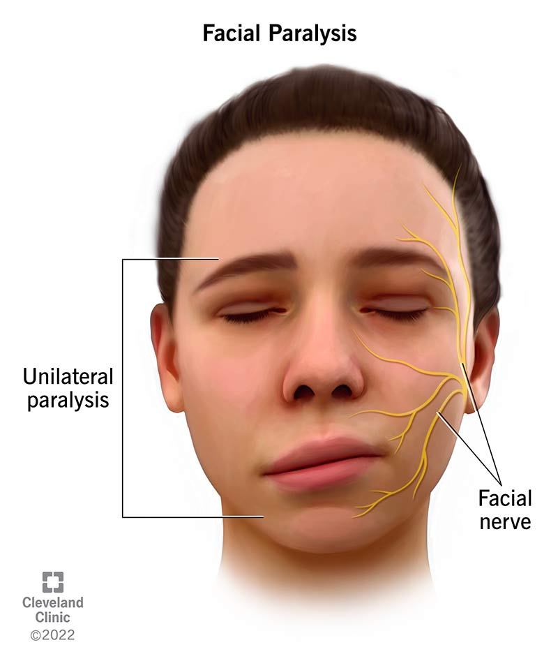 Right side of person's face drooping, indicating facial paralysis.