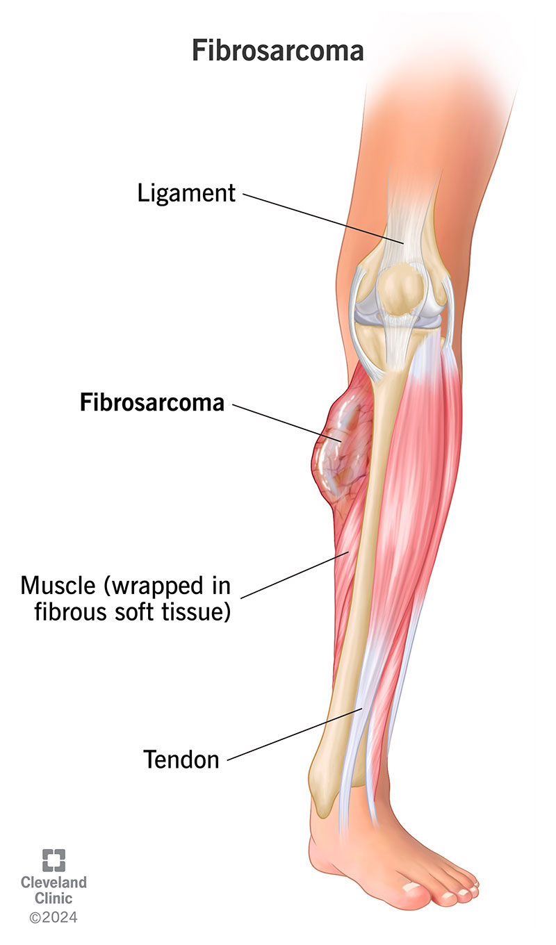 A fibrosarcoma that’s formed in the soft tissue surrounding leg muscle