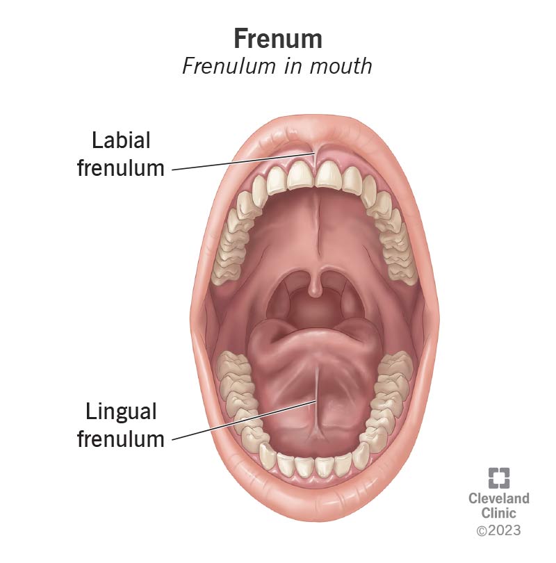 An open mouth with labial (lip) and lingual (tongue) frenums labeled.
