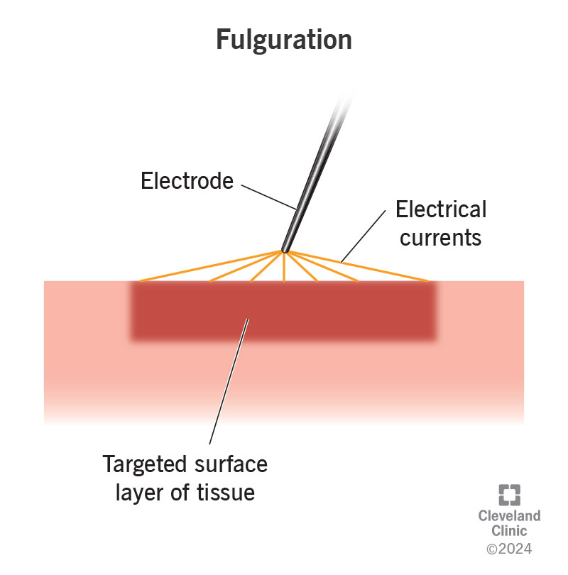 An electrode heating tissue during fulguration