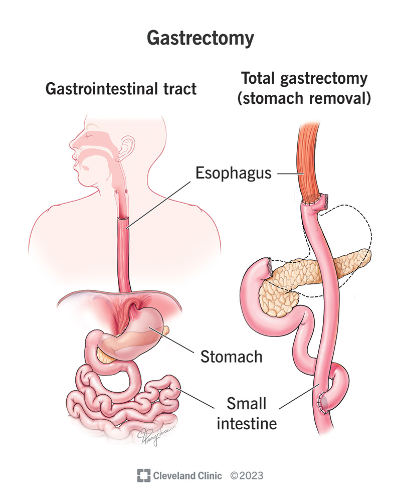 The anatomy of the gastrointestinal tract before and after a total gastrectomy (stomach removal)