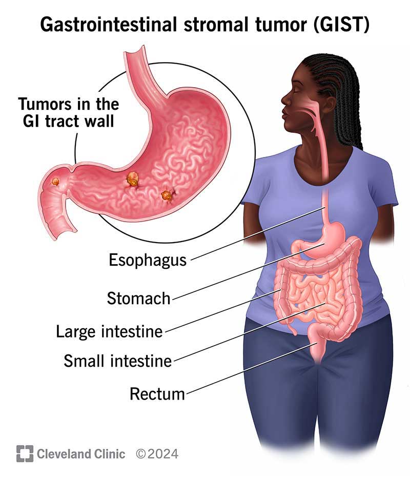 Anatomy of gastrointestinal stromal tumors (GISTS) in the walls the gastrointestinal tract