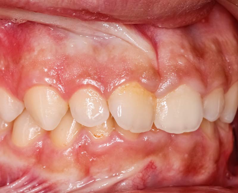 A person with gingival hyperplasia, characterized by puffy, swollen gums