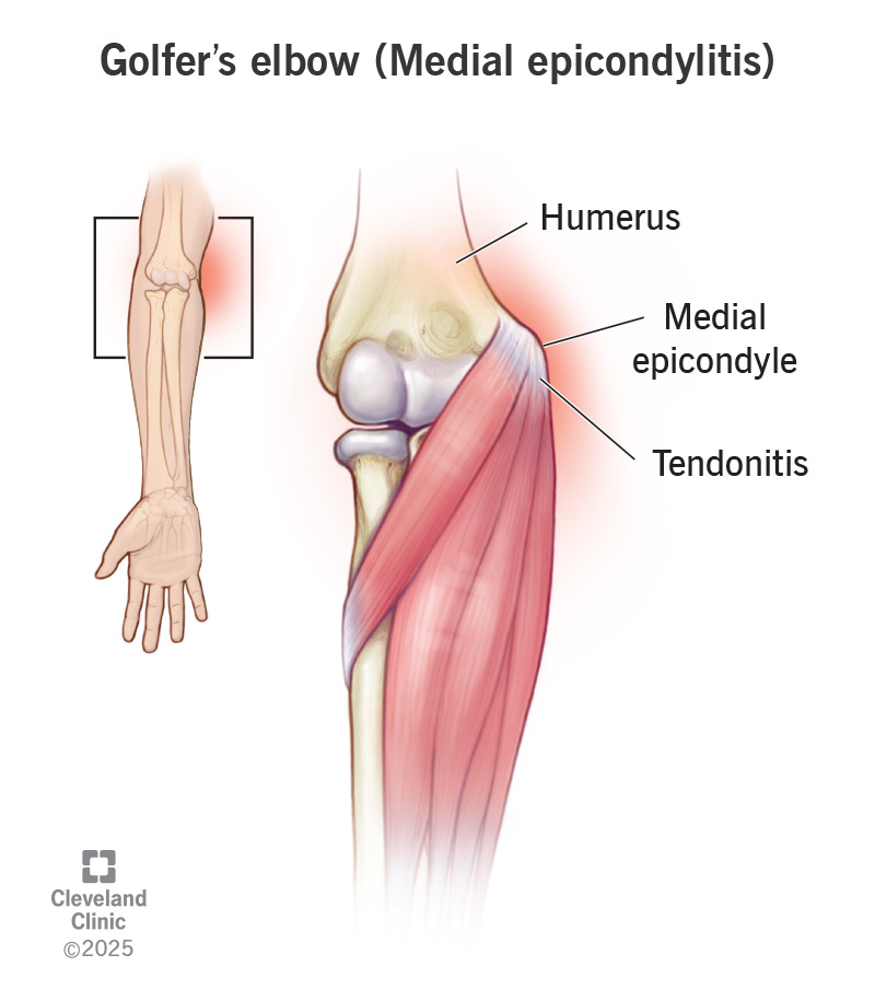 Inflammation (tendonitis) in the medial epicondyle tendon of the elbow