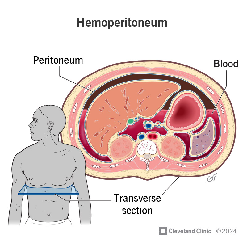 Inside view of hemoperitoneum, bleeding inside your peritoneal cavity.