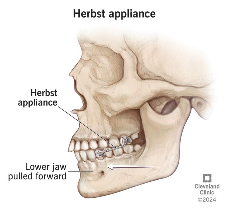 Profile view of skull wearing a Herbst appliance, showing how the appliance pulls the lower jaw forward