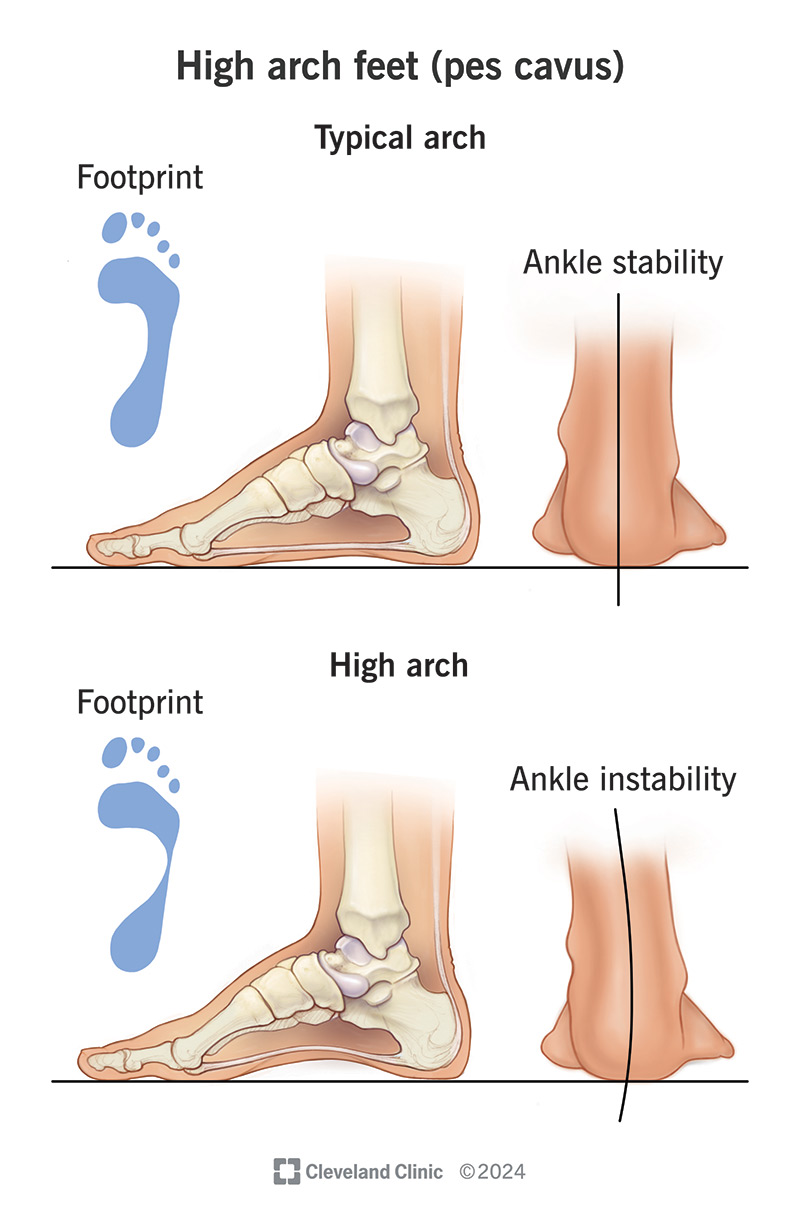 Image comparing high arch feet (pes cavus) with normal arches.