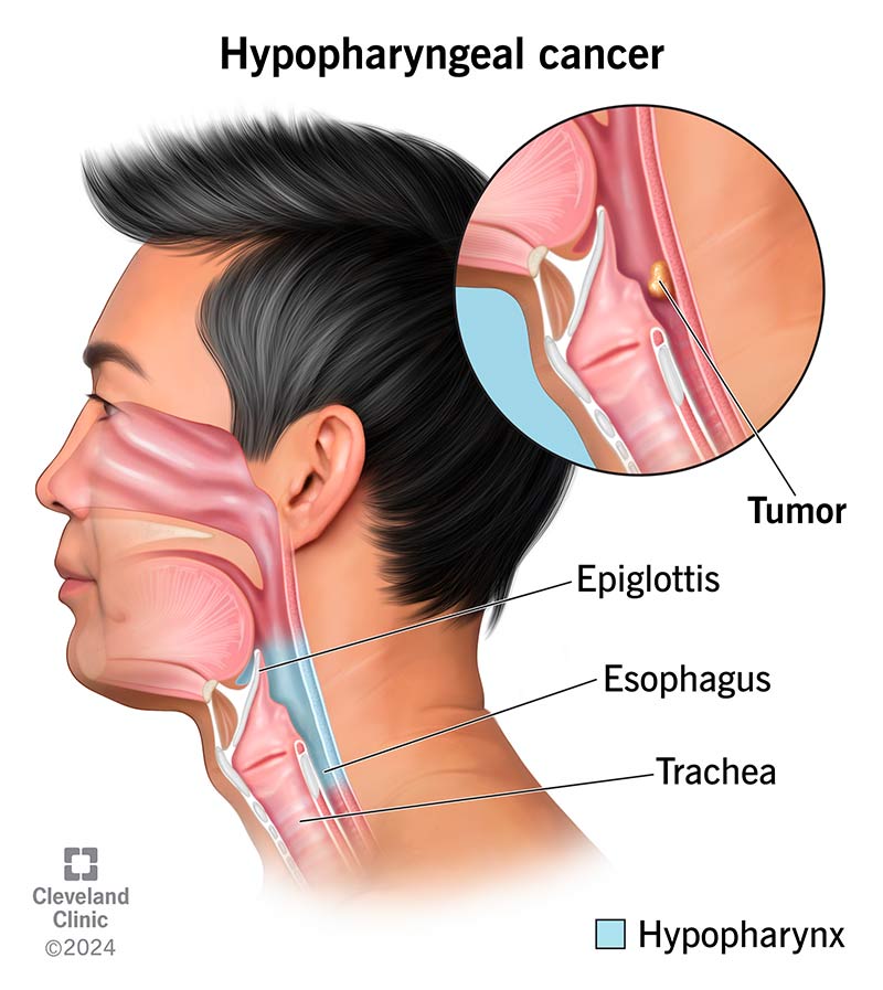 Hypopharyngeal cancer in the lower throat, with throat anatomy