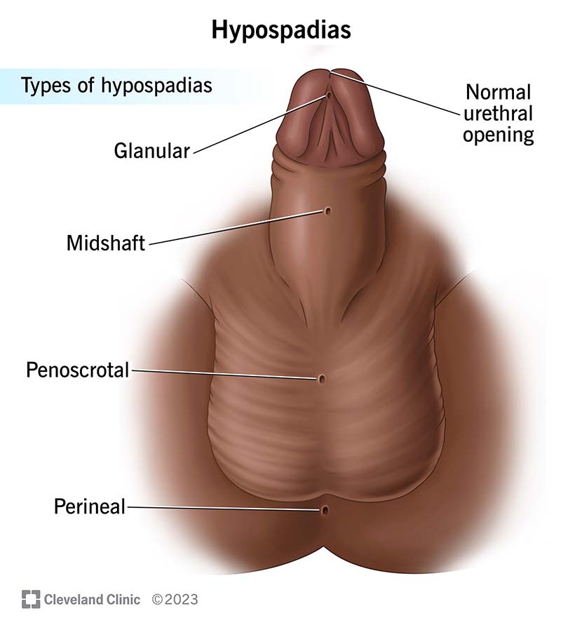Hypospadias may occur below the penis tip, along the shaft, where the penis and scrotum meet, or on or below the scrotum