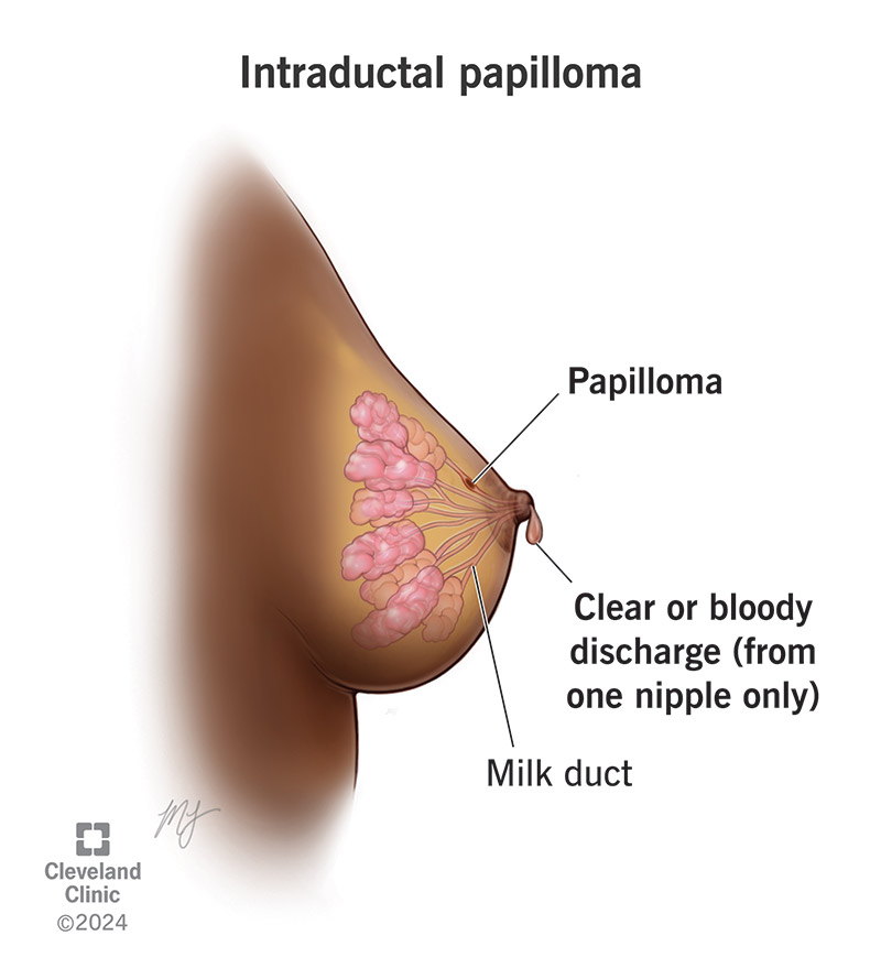 A solitary intraductal papilloma in a milk duct near the nipple