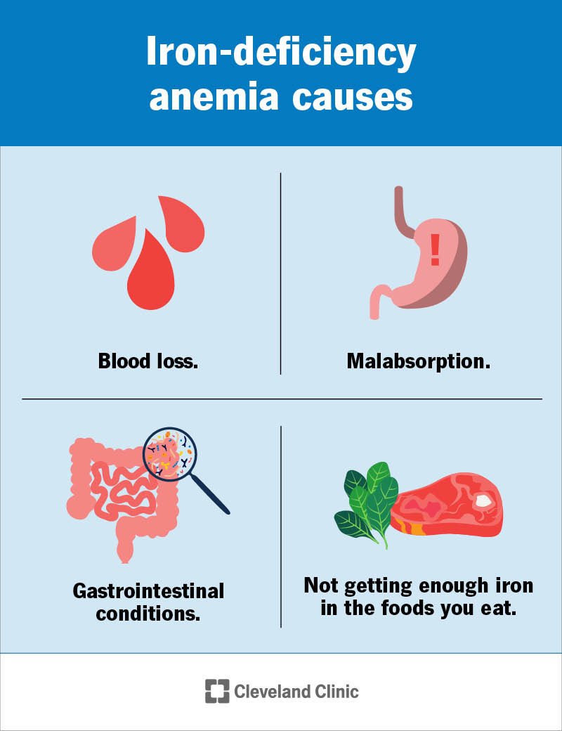 Iron-deficiency anemia causes include blood loss, GI conditions, malabsorption and not getting enough iron in your diet