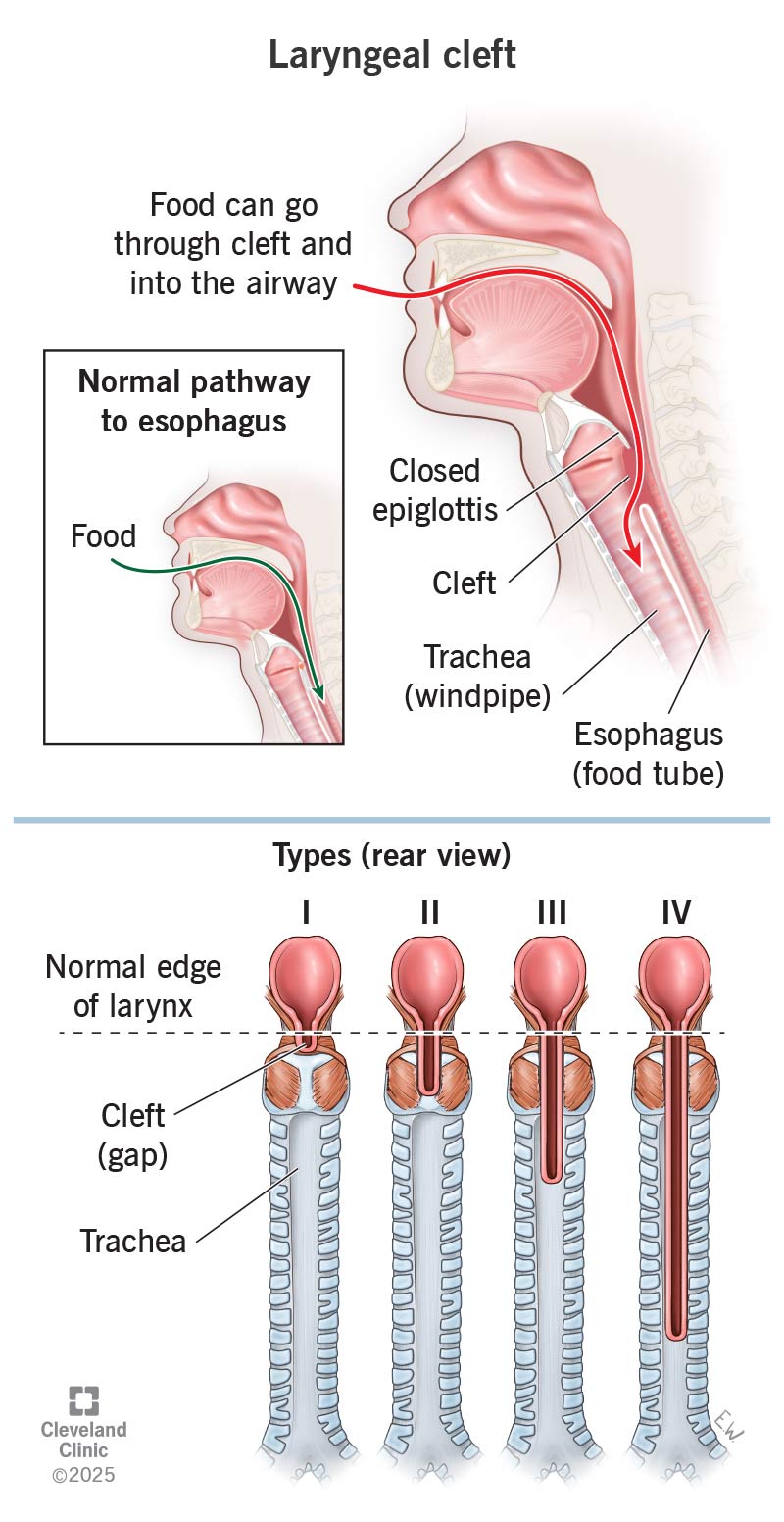 Food slipping through a laryngeal cleft (gap) into the windpipe, and a comparison of cleft types from least to most severe