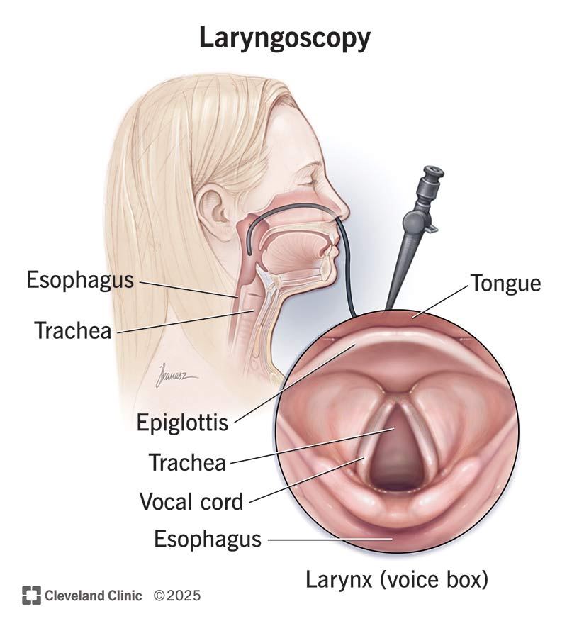 A flexible laryngoscope inserted into the nose during a laryngoscopy, which provides a close-up view of key structures