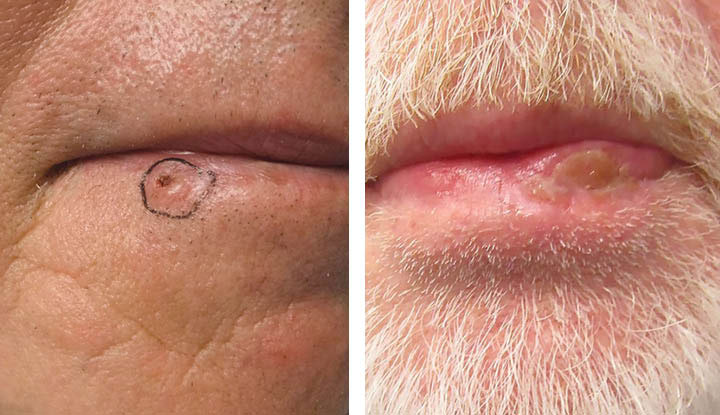 A small brown spot and a lower lip lesion associated with lip cancer