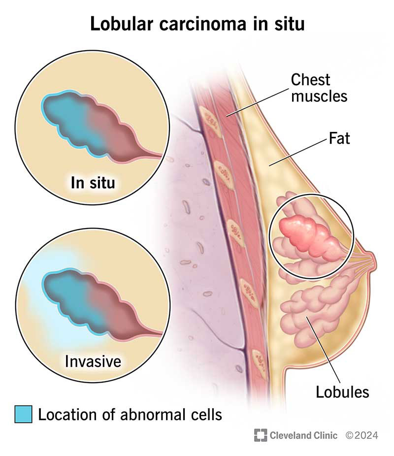 Lobular carcinoma in situ, with abnormal cells in breast