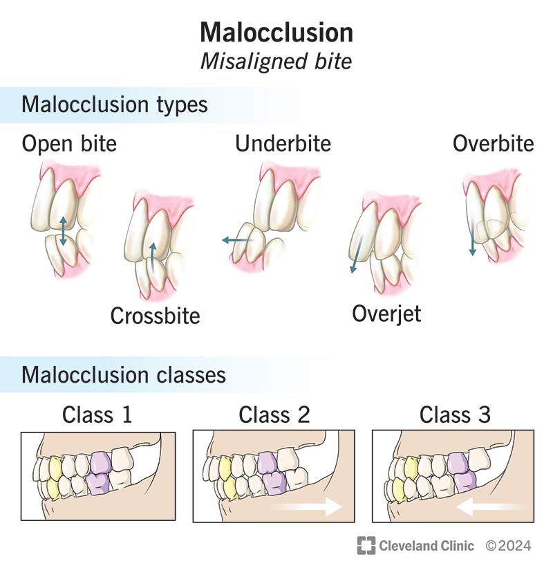 Malocclusion types include open bite, crossbite, underbite, overjet and overbite. Malocclusion classes include 1-3.