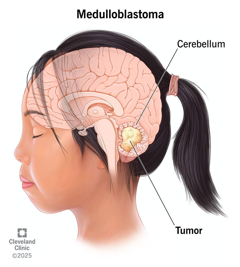 Cross-section view of person with medulloblastoma tumor in their cerebellum