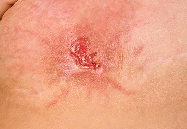 Image showing a MRSA skin infection. It’s a red, open sore with a darker crust around it. The nearby skin appears swollen