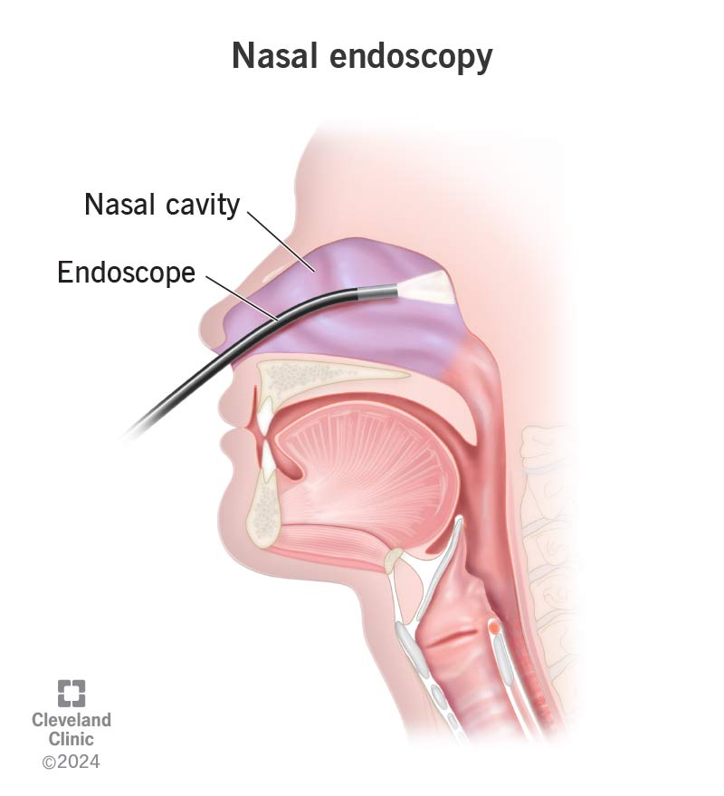 Nasal endoscopy procedure; endoscope examining nasal cavities and sinuses