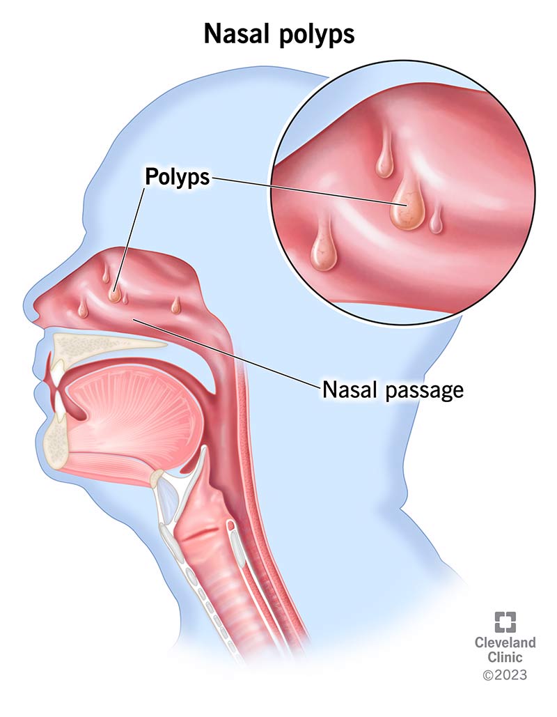 Nasal polyps forming inside of nasal passage.