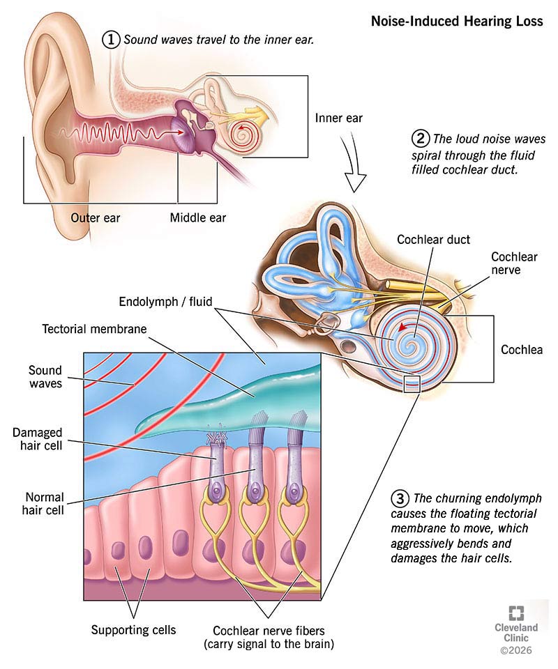 Sound waves move through the ear and affect different parts of it, causing noise-induced hearing loss