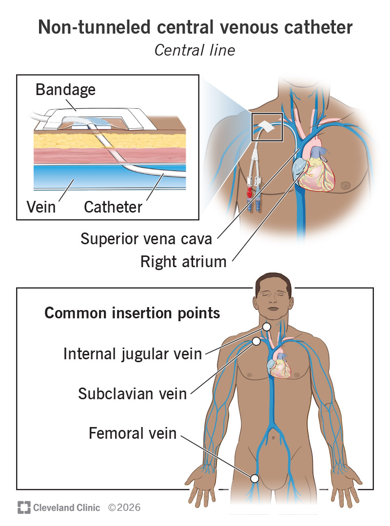 Non-tunneled central venous catheter and anatomy of common insertion points