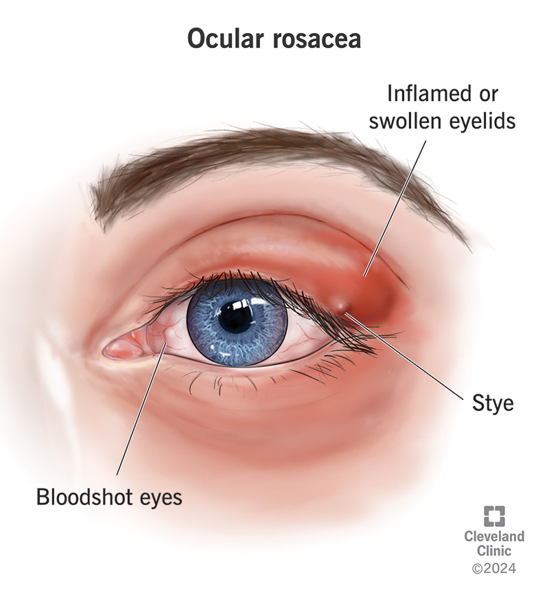 Symptoms of ocular rosacea, including stye, bloodshot eyes and inflamed or swollen eyelids