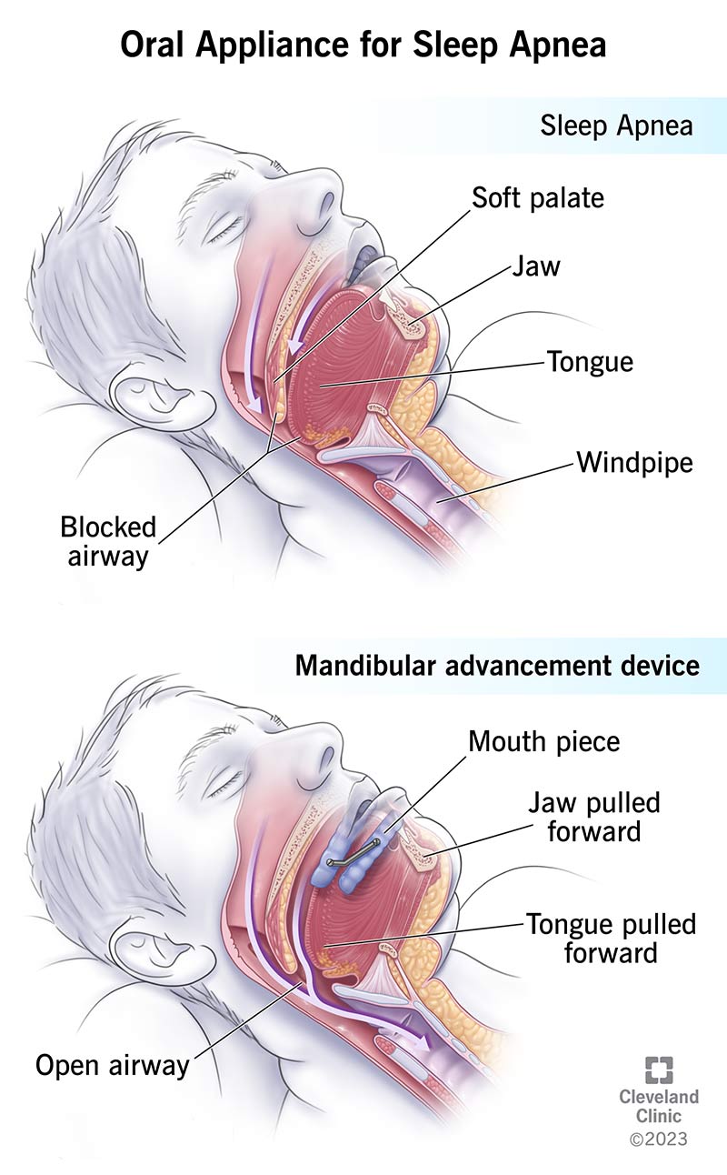 Comparison of mouth position in a person with sleep apnea both with and without a mandibular advancement device