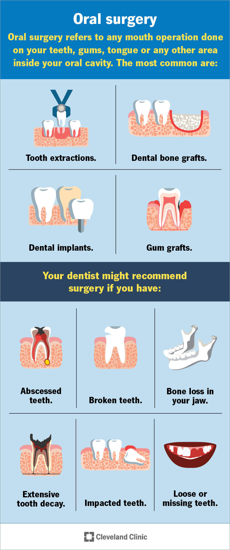 Oral surgery is any operation in your mouth, including tooth extractions, dental bone grafts, dental implants and gum grafts.