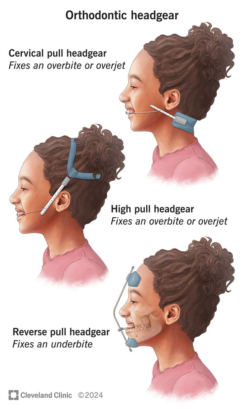 The three most common types of orthodontic headgear