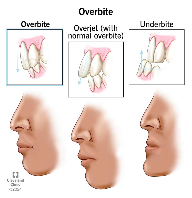 Overbite vs. overjet vs. underbite, side-by-side profile comparison of each malocclusion type.