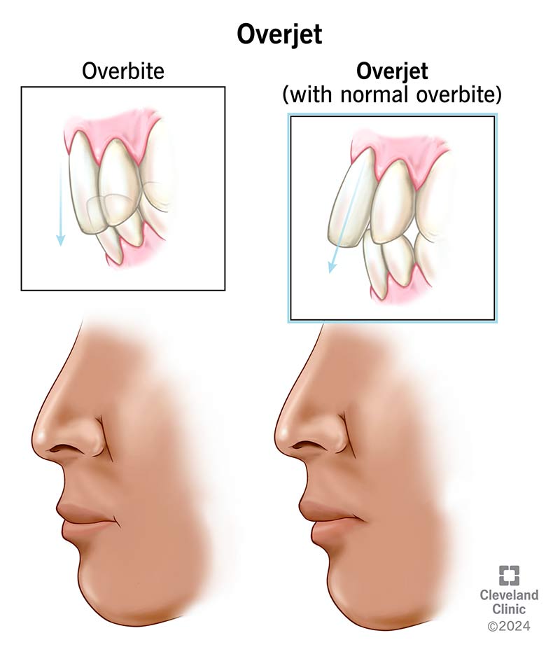 Overbite vs. overjet; profile comparison of malocclusion types