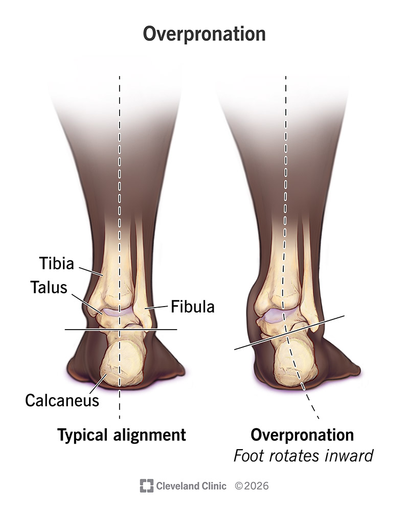 Lower leg and foot anatomy, with typical alignment versus overpronation (foot rotates inward)