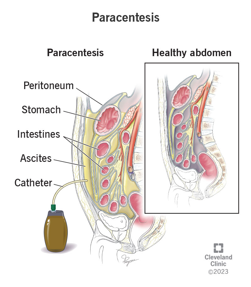 Comparison of an abdomen without ascites and an abdomen with ascites that’s being treated with paracentesis