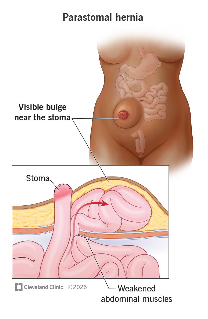 Intestine pushing through weakened ab muscles after surgery (parastomal hernia), creating a visible bulge near the stoma