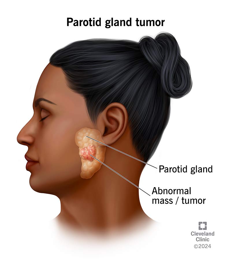 Abnormal masses or tumors that develop on your parotid gland may be benign (non-cancerous) or malignant (cancerous).