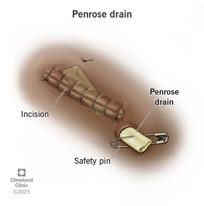 A penrose drain held in place with a safety pin.