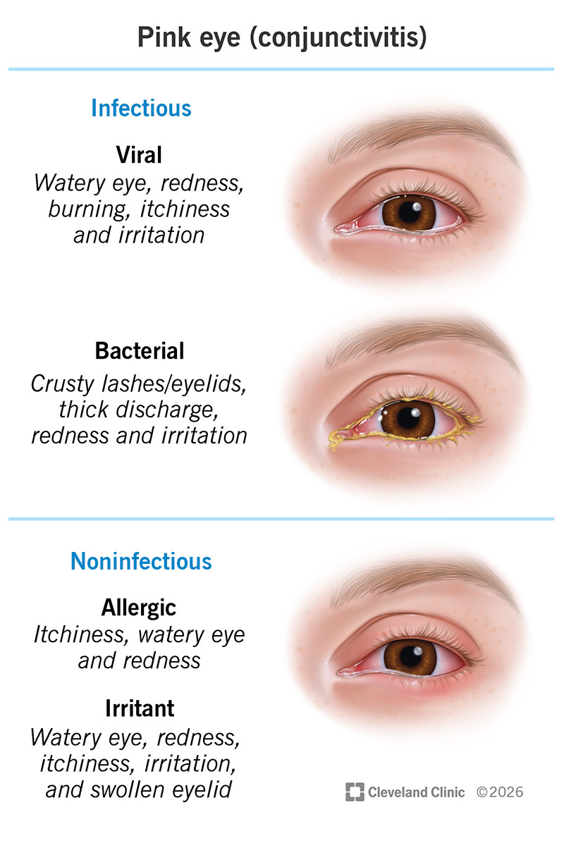 Pink eye symptoms and causes