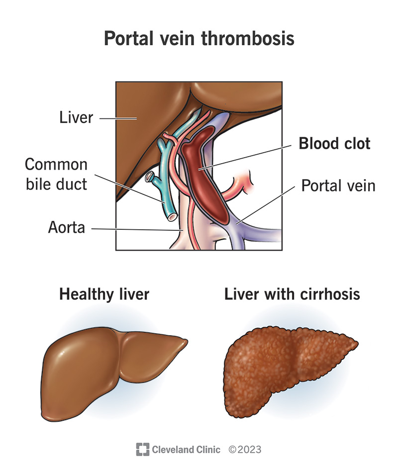 Illustration of a blood clot in a portal vein. Two smaller illustrations compare a healthy liver to one with cirrhosis.
