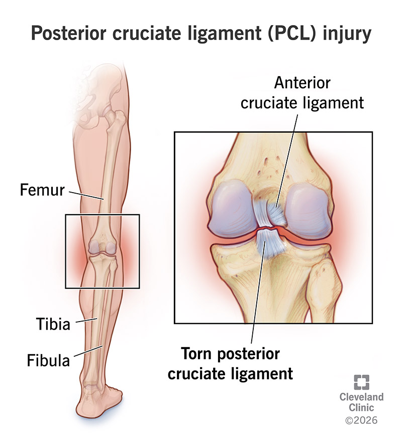 Leg anatomy and PCL injury with a complete tear