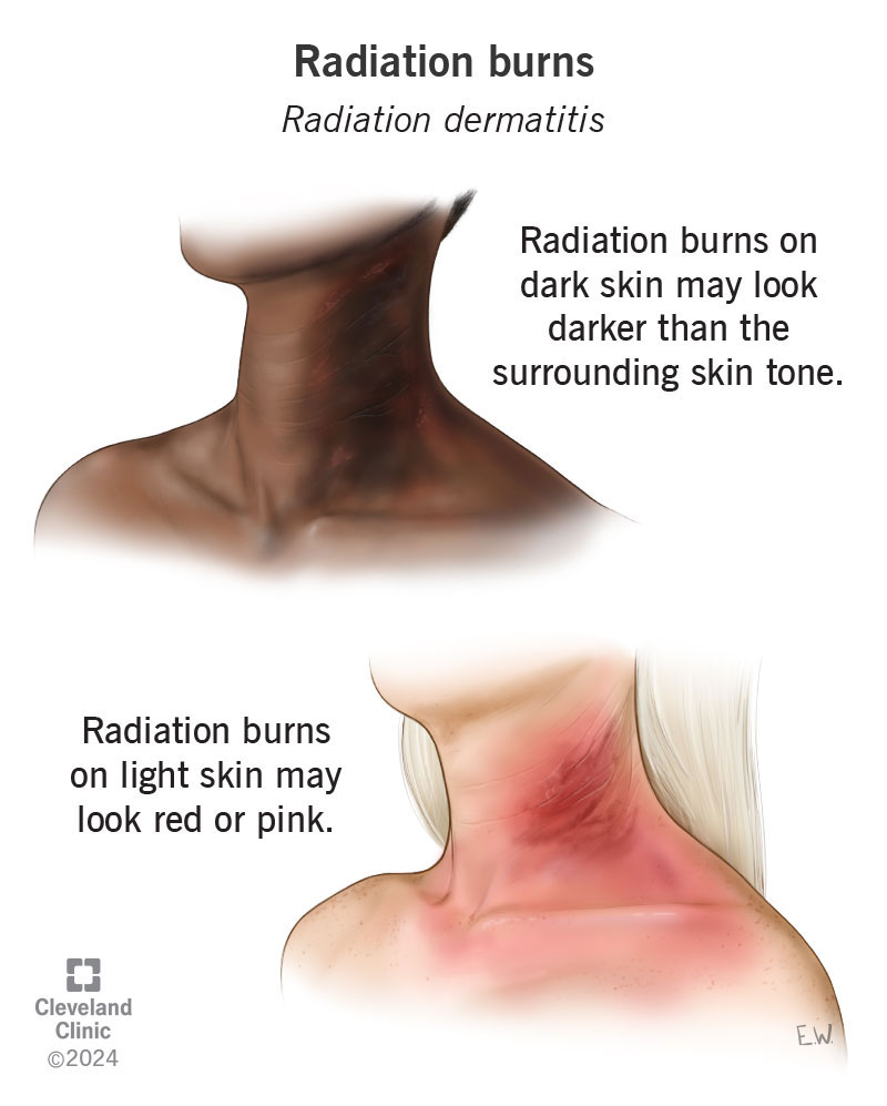 Radiation burns on dark and light skin