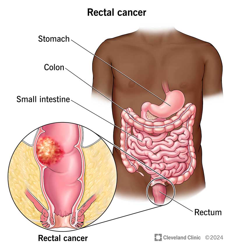 Rectal cancer in lining of rectum, with stomach, colon and small intestine