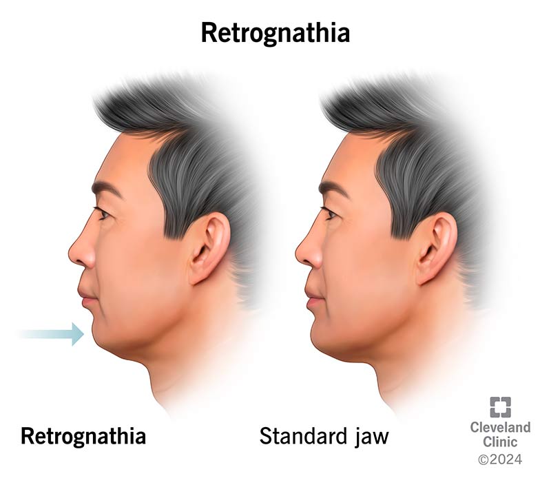 A profile view of a person with retrognathia vs. a standard jaw