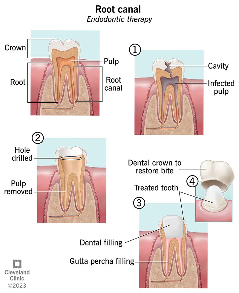 Steps of a root canal procedure where the dentist will remove infected pulp from the tooth and add a filling and crown.