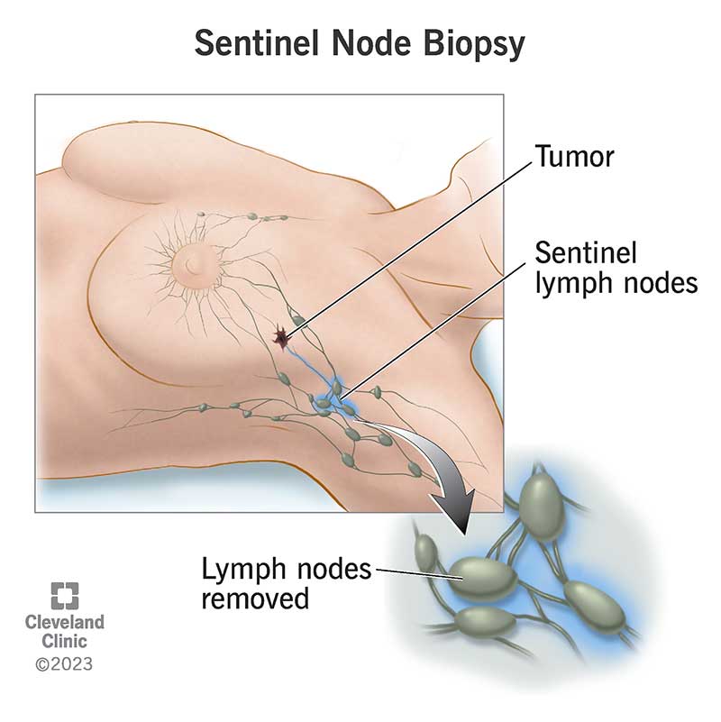 Sentinel lymph nodes inside the breast and armpit