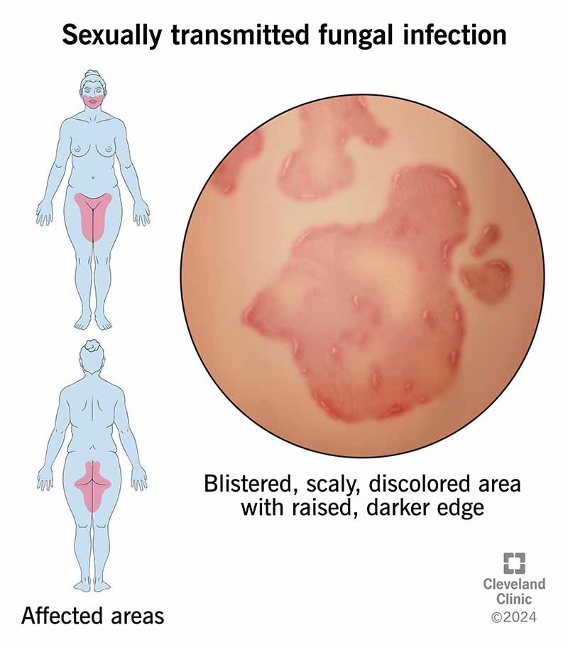 Sexually transmitted fungal infection rash that’s red and circular with darker borders. Affected areas are highlighted